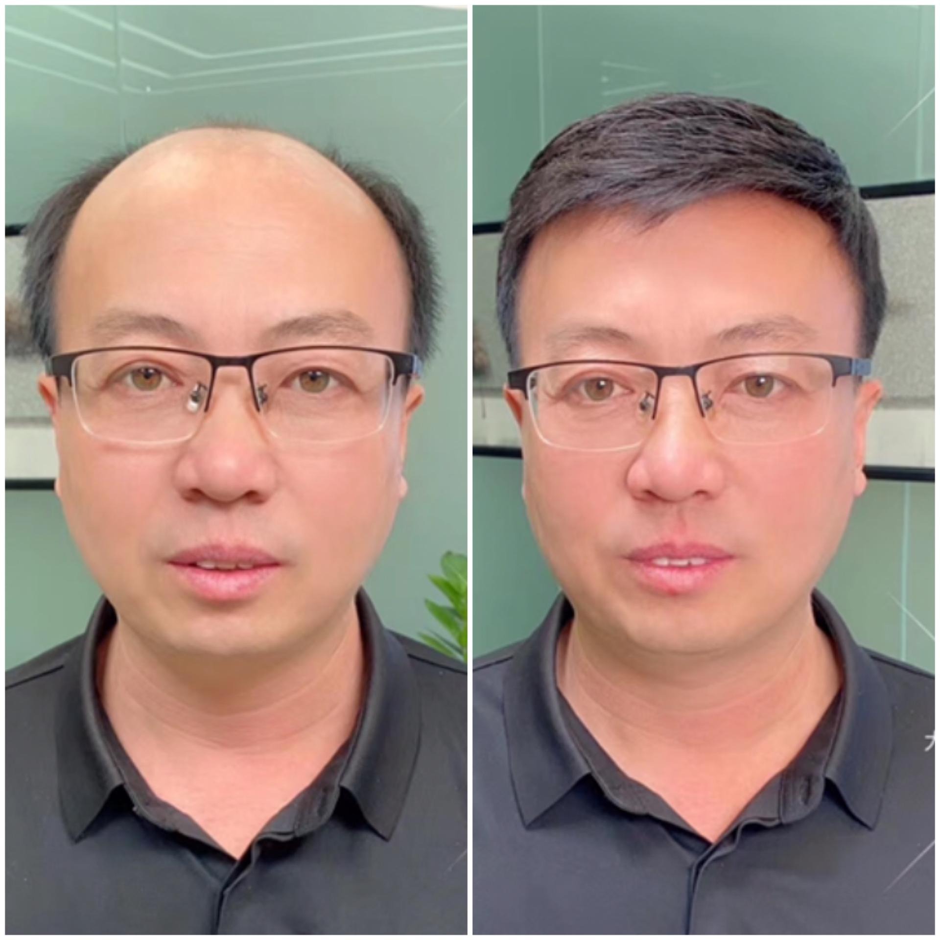 惠州无痕增发补发 惠州假发 量头订制修剪发型 补发可以比同龄人年轻