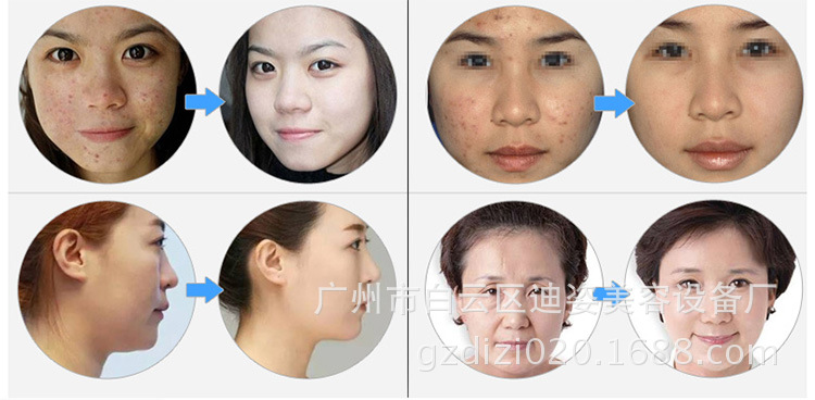 厂家新款韩国皮肤管理光动力美容仪美白淡斑红蓝光光动力美容仪示例图10